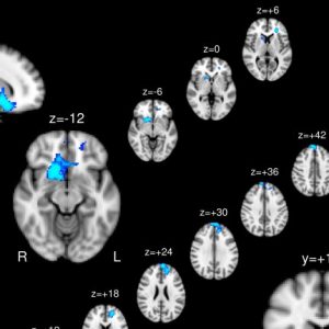 This figure from Ikuta and Kiparizoska’s paper shows parts of the brain that exhibit less symphony with the anterior piriform cortex, the region of the brain associated with the sense of smell. The main region, seen in the three larger images, is the nucleus accumbens, which has been indicated in previous studies to be associated with auditory hallucinations. Submitted photo